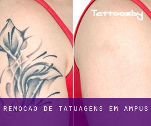 Remoção de tatuagens em Ampus