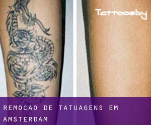 Remoção de tatuagens em Amsterdam