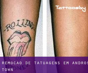 Remoção de tatuagens em Andros Town