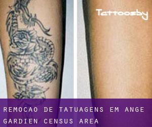 Remoção de tatuagens em Ange-Gardien (census area)