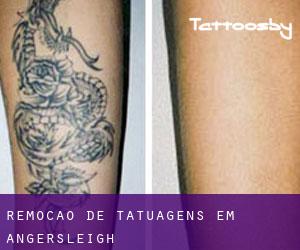 Remoção de tatuagens em Angersleigh