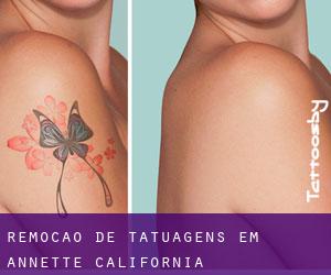 Remoção de tatuagens em Annette (California)