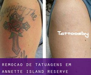 Remoção de tatuagens em Annette Island Reserve