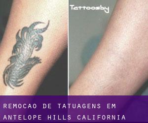 Remoção de tatuagens em Antelope Hills (California)