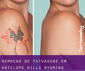 Remoção de tatuagens em Antelope Hills (Wyoming)