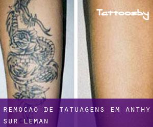 Remoção de tatuagens em Anthy-sur-Léman