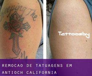Remoção de tatuagens em Antioch (California)