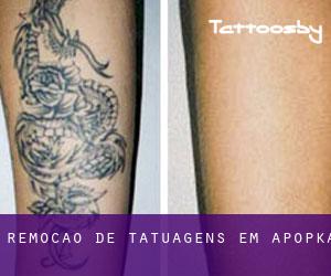Remoção de tatuagens em Apopka