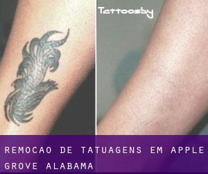 Remoção de tatuagens em Apple Grove (Alabama)