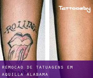 Remoção de tatuagens em Aquilla (Alabama)