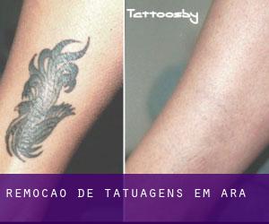 Remoção de tatuagens em Ara