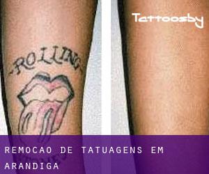 Remoção de tatuagens em Arándiga