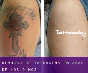 Remoção de tatuagens em Aras de los Olmos