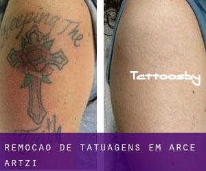 Remoção de tatuagens em Arce / Artzi
