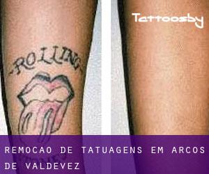 Remoção de tatuagens em Arcos de Valdevez