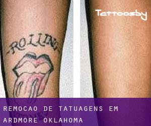 Remoção de tatuagens em Ardmore (Oklahoma)