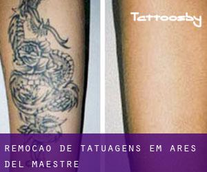 Remoção de tatuagens em Ares del Maestre