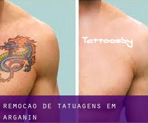 Remoção de tatuagens em Argañín