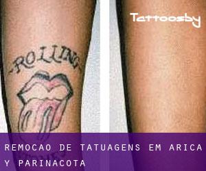Remoção de tatuagens em Arica y Parinacota