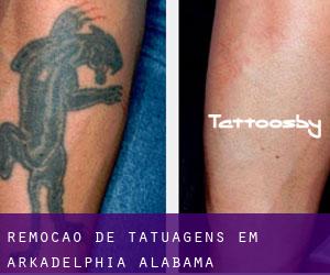 Remoção de tatuagens em Arkadelphia (Alabama)