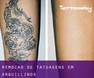 Remoção de tatuagens em Arquillinos