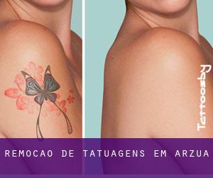 Remoção de tatuagens em Arzúa