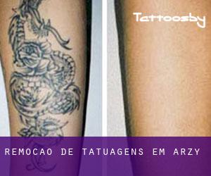 Remoção de tatuagens em Arzy