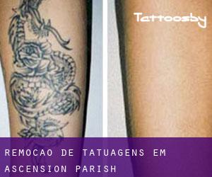 Remoção de tatuagens em Ascension Parish