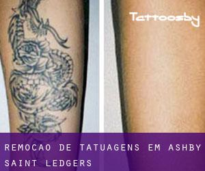 Remoção de tatuagens em Ashby Saint Ledgers