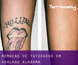 Remoção de tatuagens em Ashland (Alabama)