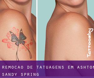 Remoção de tatuagens em Ashton-Sandy Spring