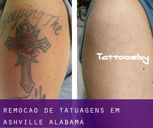 Remoção de tatuagens em Ashville (Alabama)
