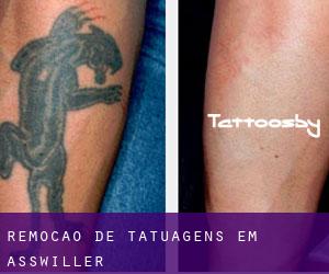 Remoção de tatuagens em Asswiller
