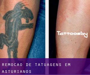 Remoção de tatuagens em Asturianos