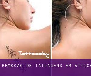 Remoção de tatuagens em Attica