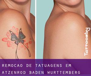 Remoção de tatuagens em Atzenrod (Baden-Württemberg)