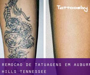 Remoção de tatuagens em Auburn Hills (Tennessee)