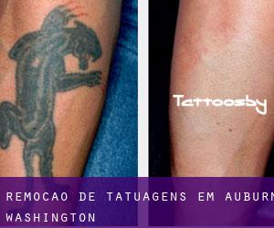 Remoção de tatuagens em Auburn (Washington)