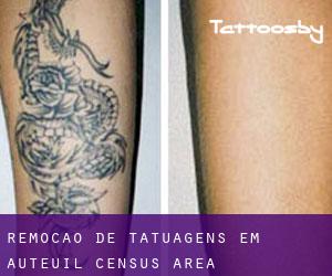 Remoção de tatuagens em Auteuil (census area)