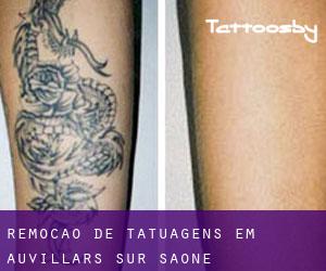 Remoção de tatuagens em Auvillars-sur-Saône