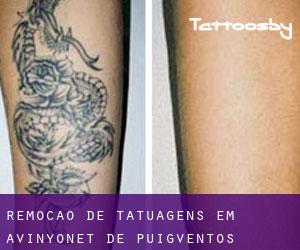 Remoção de tatuagens em Avinyonet de Puigventós