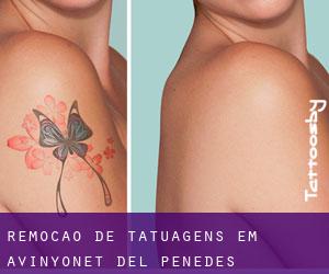 Remoção de tatuagens em Avinyonet del Penedès
