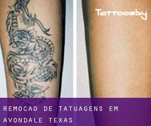 Remoção de tatuagens em Avondale (Texas)
