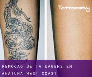 Remoção de tatuagens em Awatuna (West Coast)