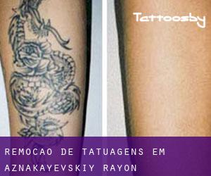 Remoção de tatuagens em Aznakayevskiy Rayon