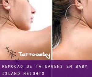 Remoção de tatuagens em Baby Island Heights
