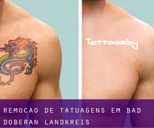 Remoção de tatuagens em Bad Doberan Landkreis