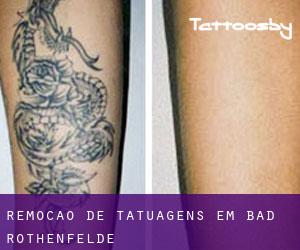 Remoção de tatuagens em Bad Rothenfelde
