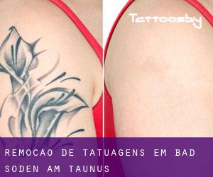 Remoção de tatuagens em Bad Soden am Taunus
