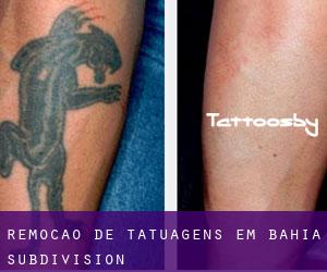 Remoção de tatuagens em Bahia Subdivision